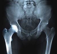 Hip Osteoporosis 