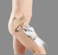 Minimally Invasive Total Hip Replacement 